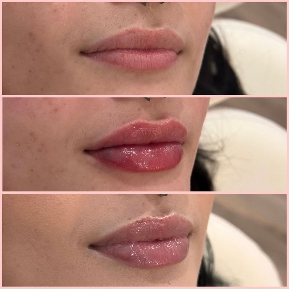 lip-filler