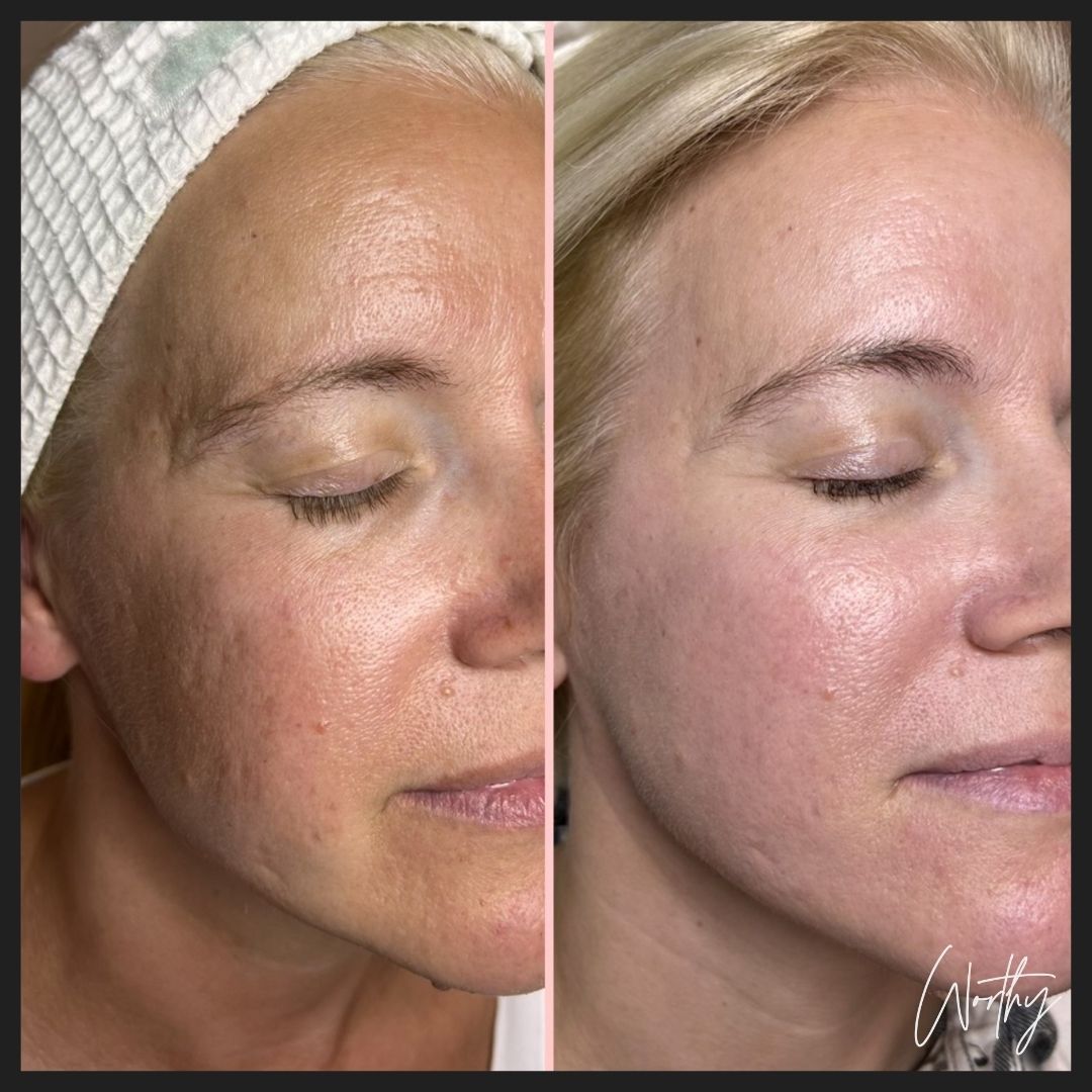 A patient's before-and-after photos show her smoother, glowing complexion after microneedling with PRP near Kitchener.