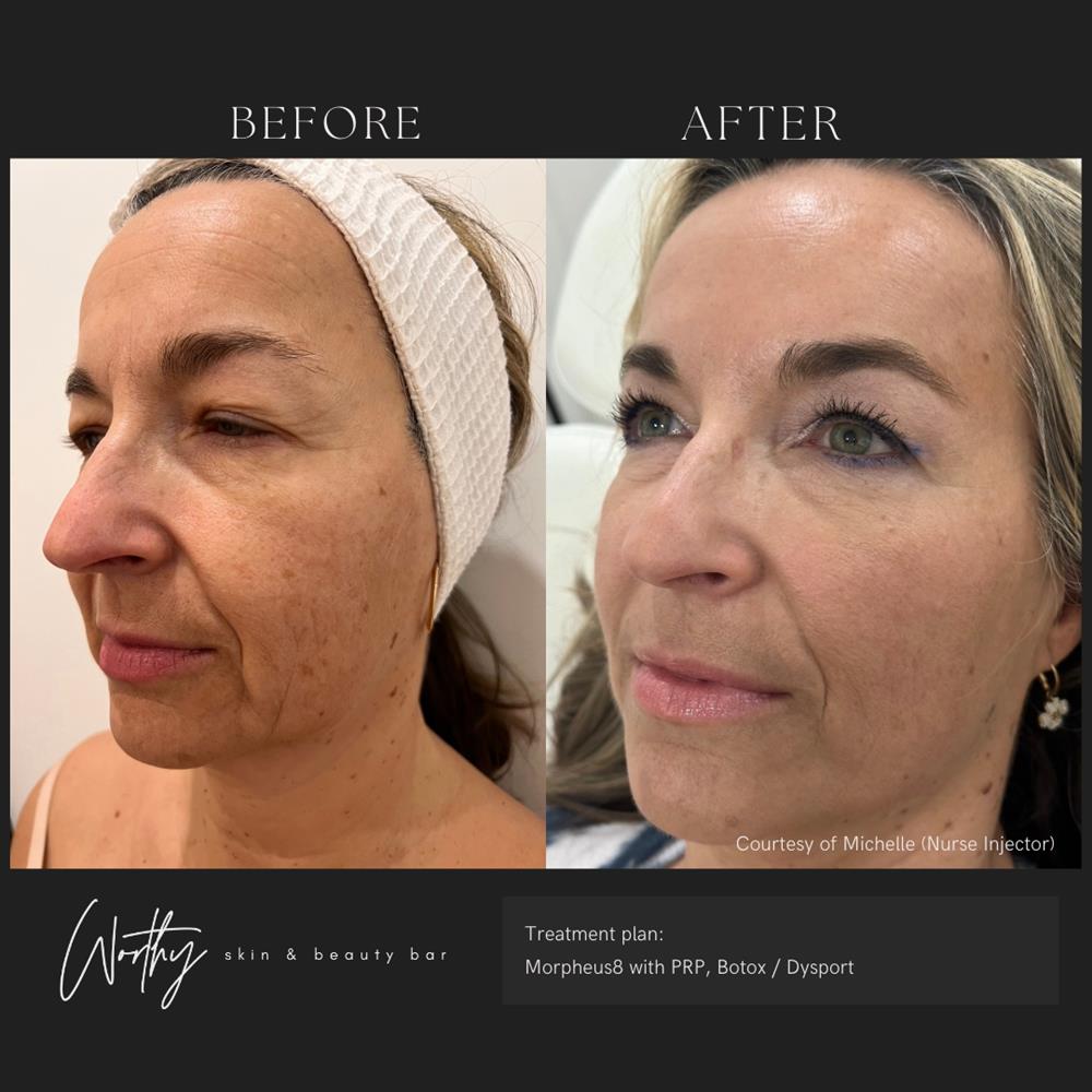 A patient's before-and-after photos reflect her complexion following Morpheus8 near Cambridge.