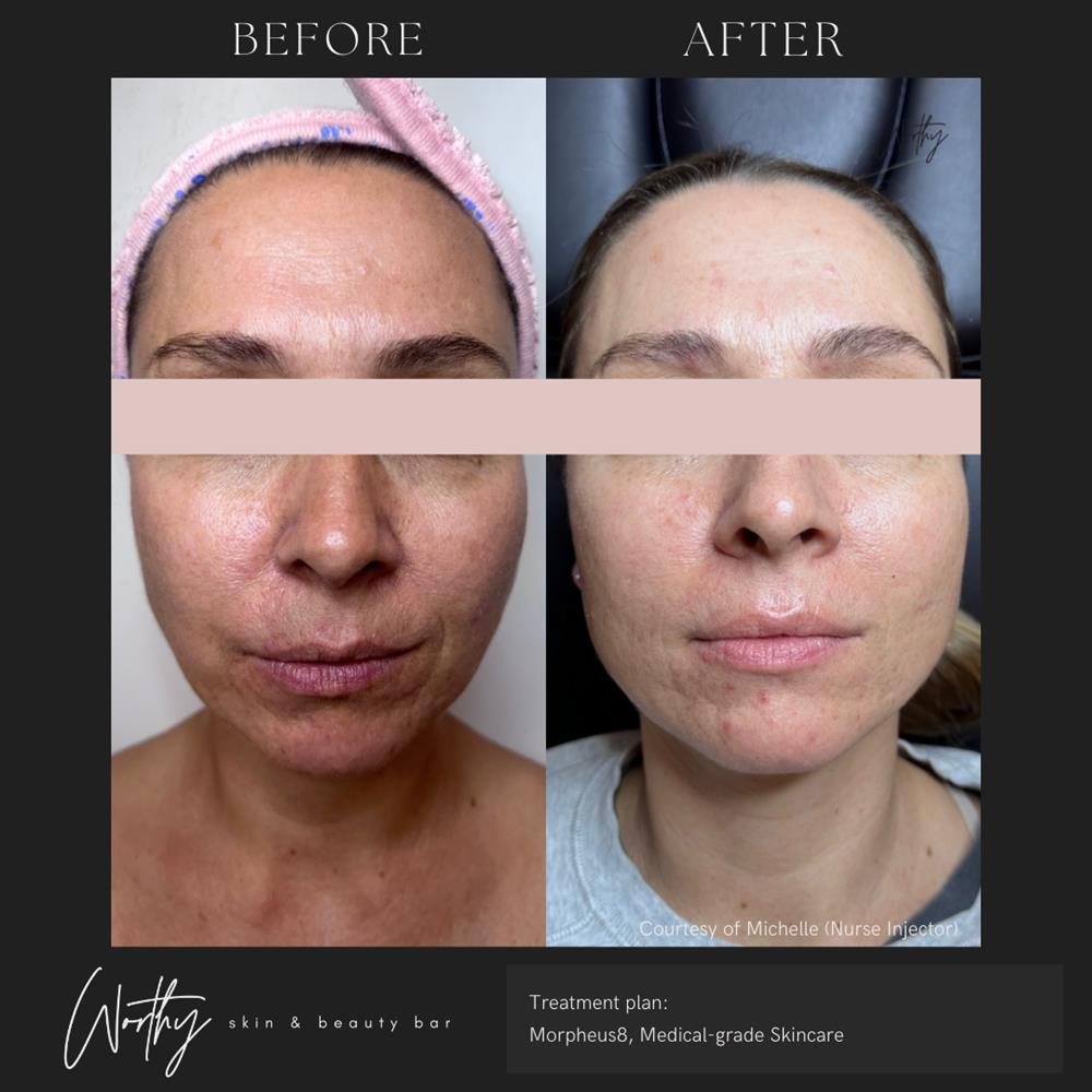 A client's before-and-after photos her glowing skin after her appointment for Morpheus8 near Kitchener.