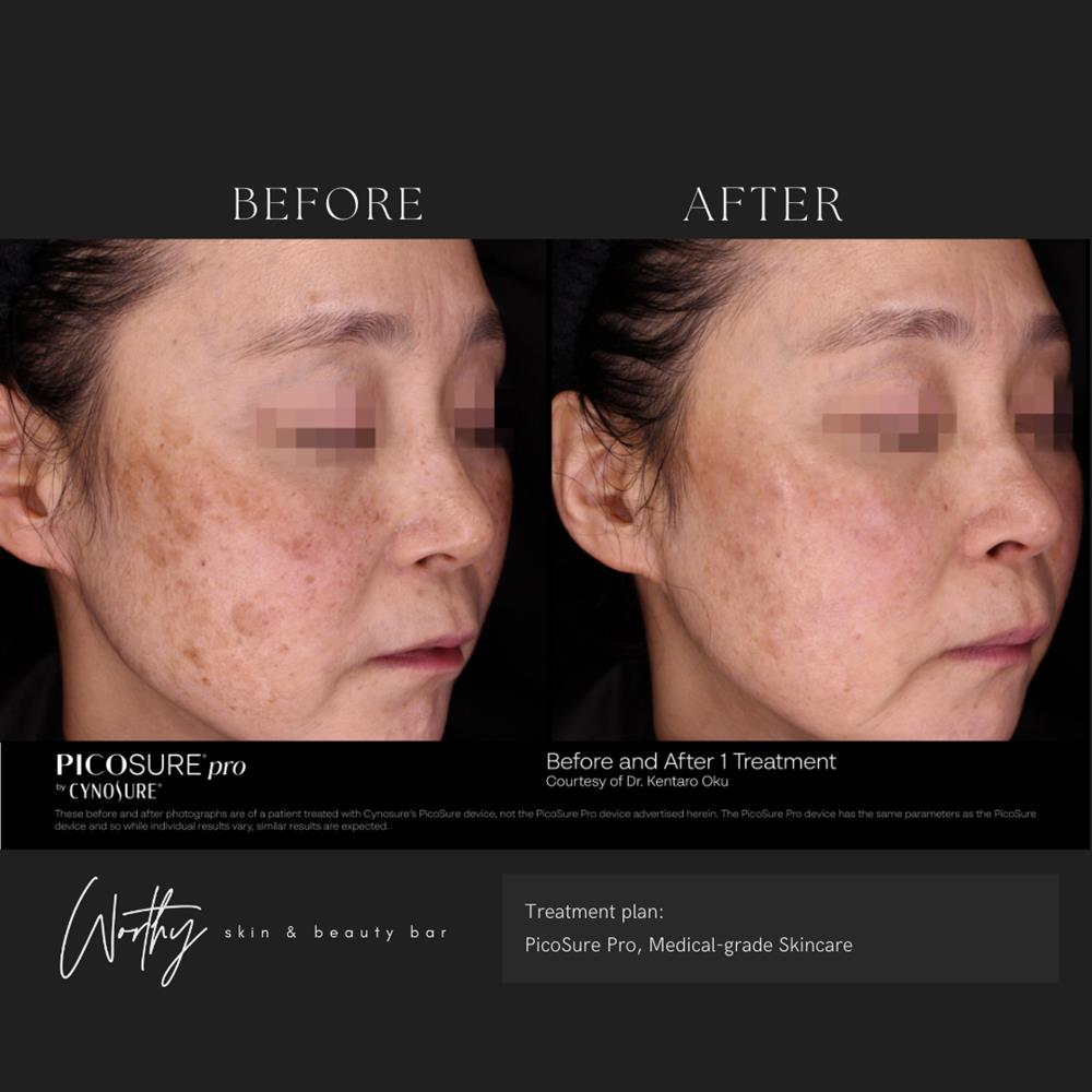 A patient's before-and-after photo reveal the clarifying results of laser skin resurfacing near Kitchener.