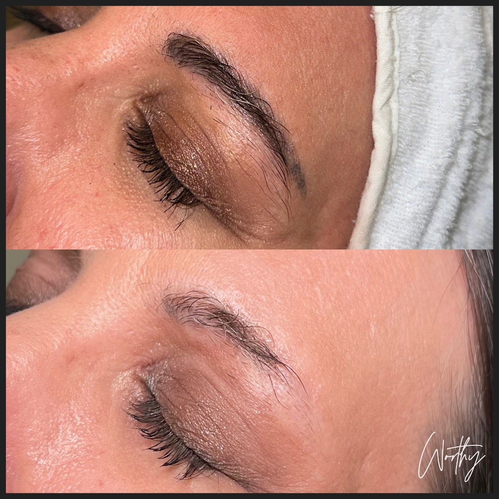 A tattoo removal before and after in Kitchener of a woman's eyebrows that have the tattooing erased.