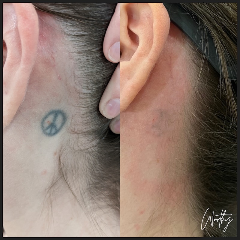 A tattoo removal before and after in Kitchener of a peace sign behind a woman's ear that's almost completely gone now.