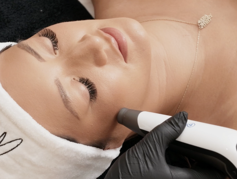  A Worthy provider passes the DP4 stylus across a patient's skin during microneedling near Waterloo, Ontario.