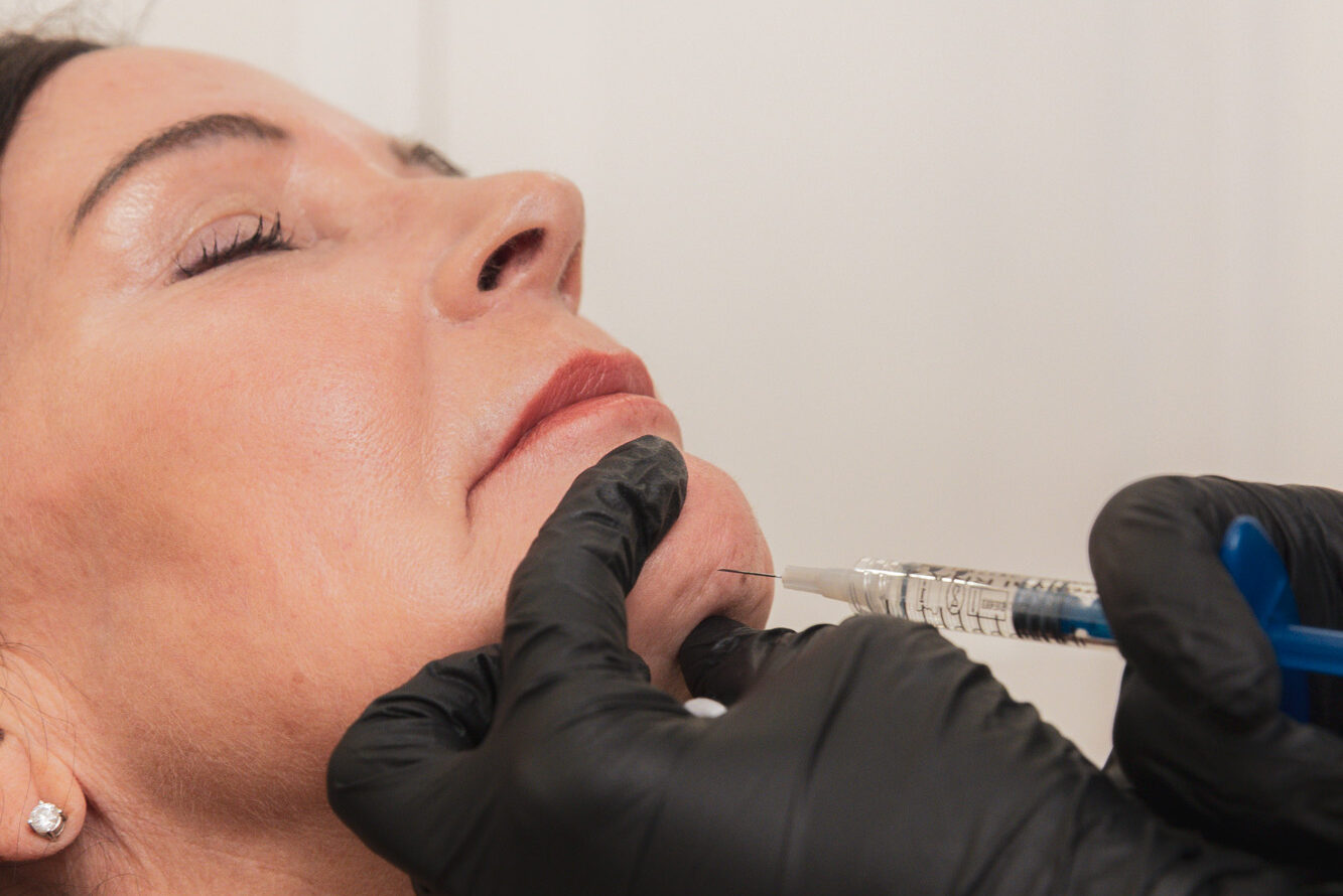 A Worthy injector expertly places dermal filler to build chin projection, a treatment commonly combined with Dysport in Kitchener.