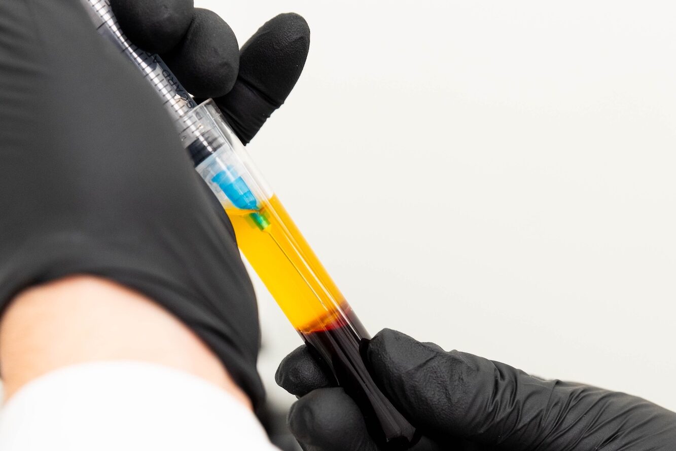 A provider prepares the platelet-rich plasma serum for PRP treatment near Kitchener.