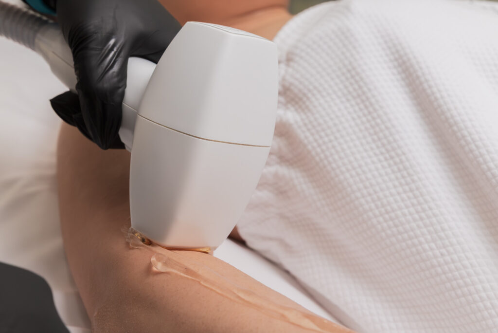 A medical aesthetician applies the DiolazeXL device to perform a patient's laser hair removal near Kitchener.