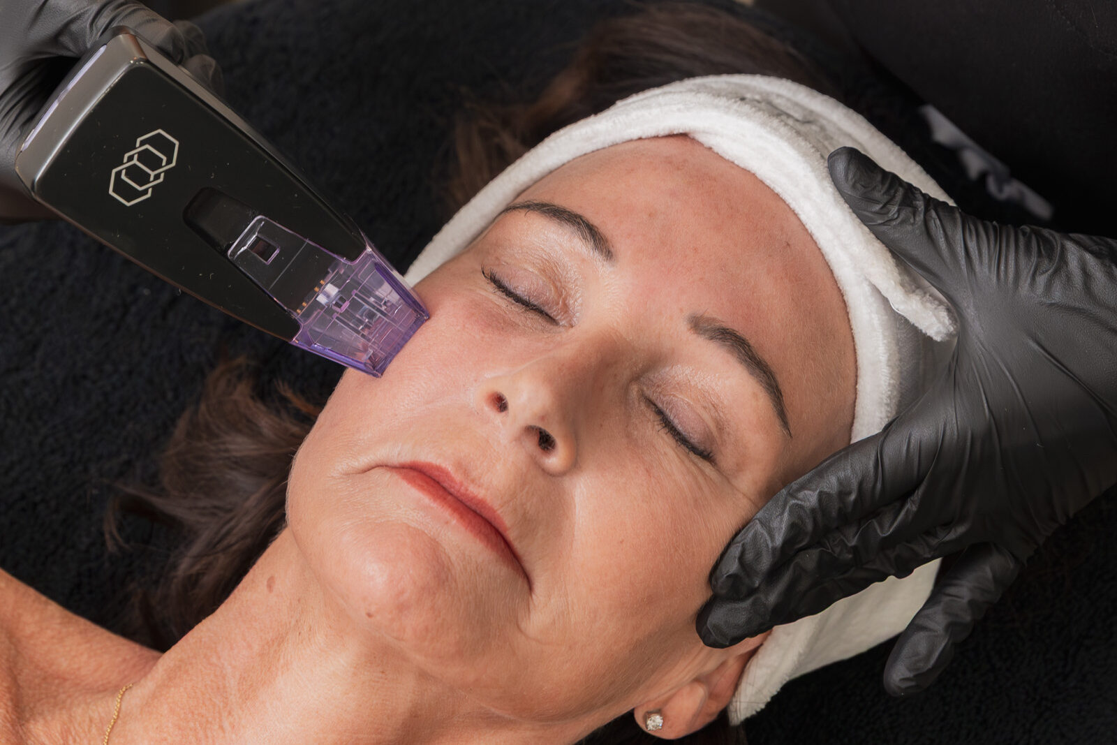 A client receives treatment with the Morpheus8 device near Cambridge.